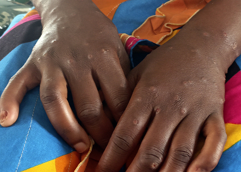 Mpox scars as seen on a patient in the Democratic Republic of Congo, March 6, 2025. /CFP