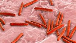 South Africa team develops handheld tool to boost TB detection