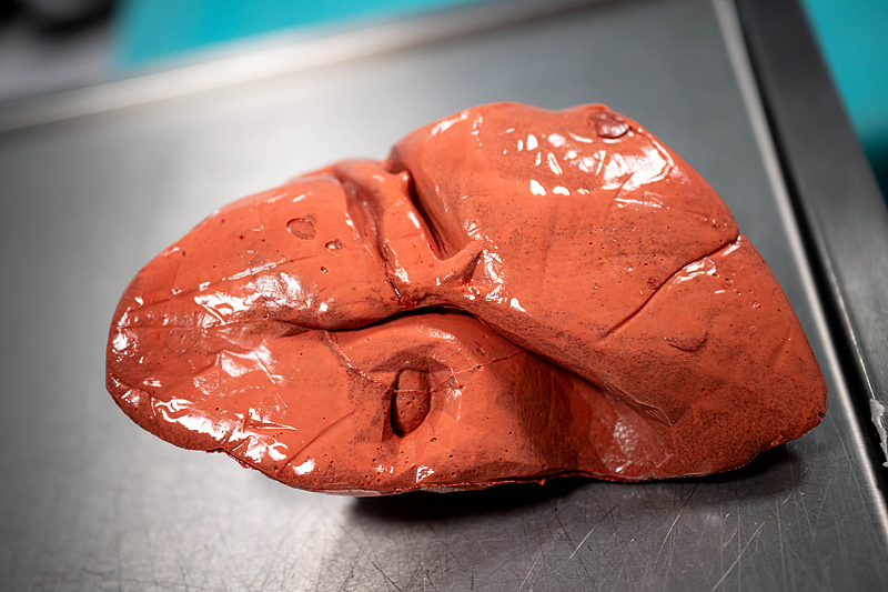 Oldenburg, Lower Saxony, Germany, a patient's liver model is placed in the 